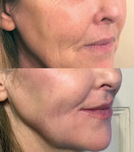 Lip transformation