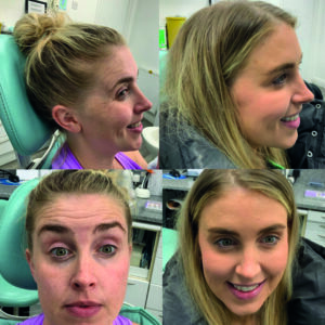 Before and after a Harmonyca skin booster treatment-before-after-3