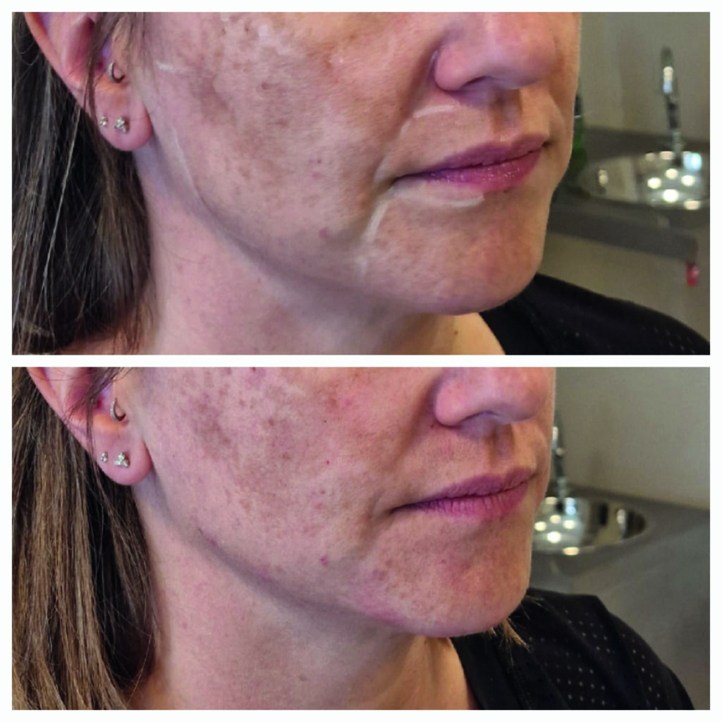 Natural results from Dermal Filler